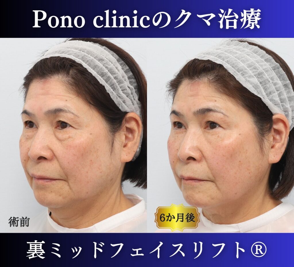 目の下のたるみ、クマ取り、60代女性の症例 (4)