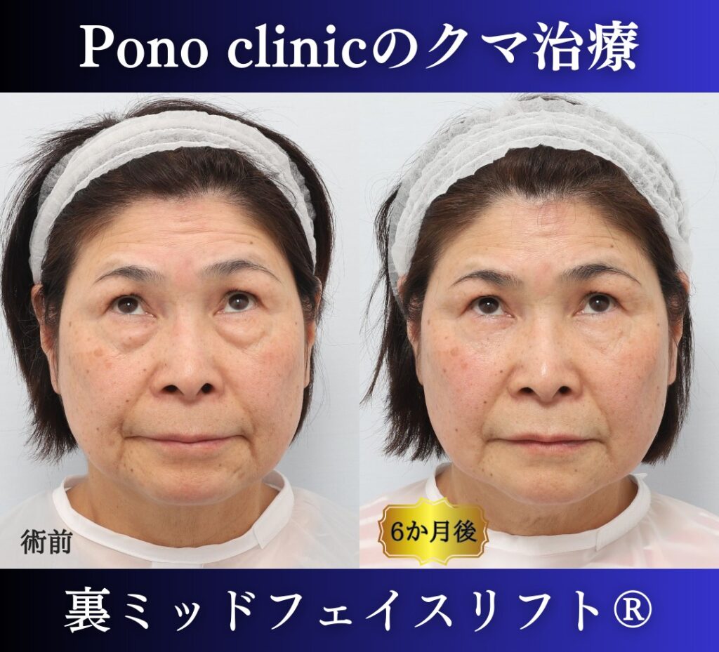 目の下のたるみ、クマ取り、60代女性の症例 (5)