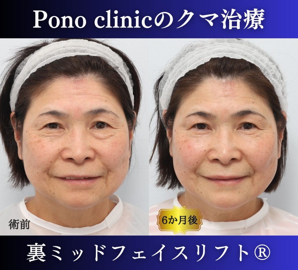 目の下のたるみ、クマ取り、60代女性の症例 (6)