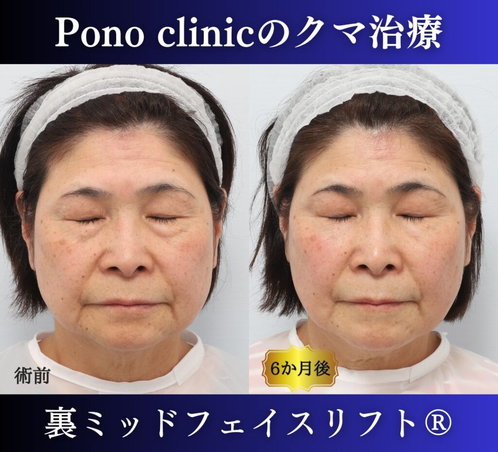 目の下のたるみ、クマ取り、60代女性の症例 (7)