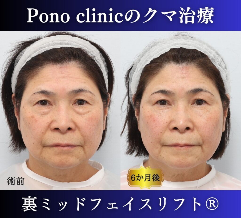 目の下のたるみ、クマ取り、60代女性の症例 (8)