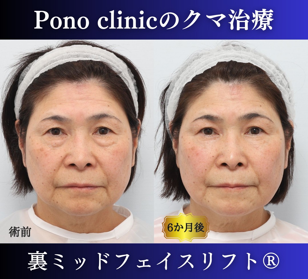 目の下のたるみ、クマ取り、60代女性の症例 (8)