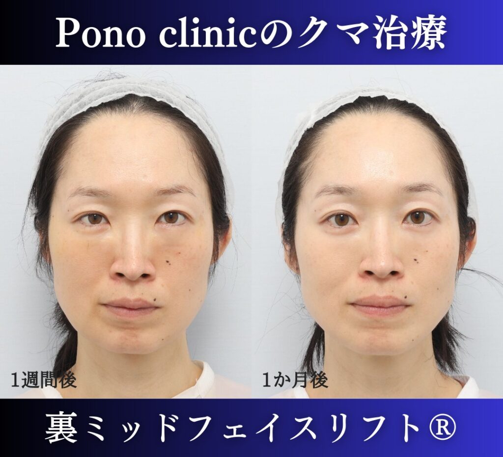 目の下のクマ取り、ハムラ法、40代女性の症例 (1)