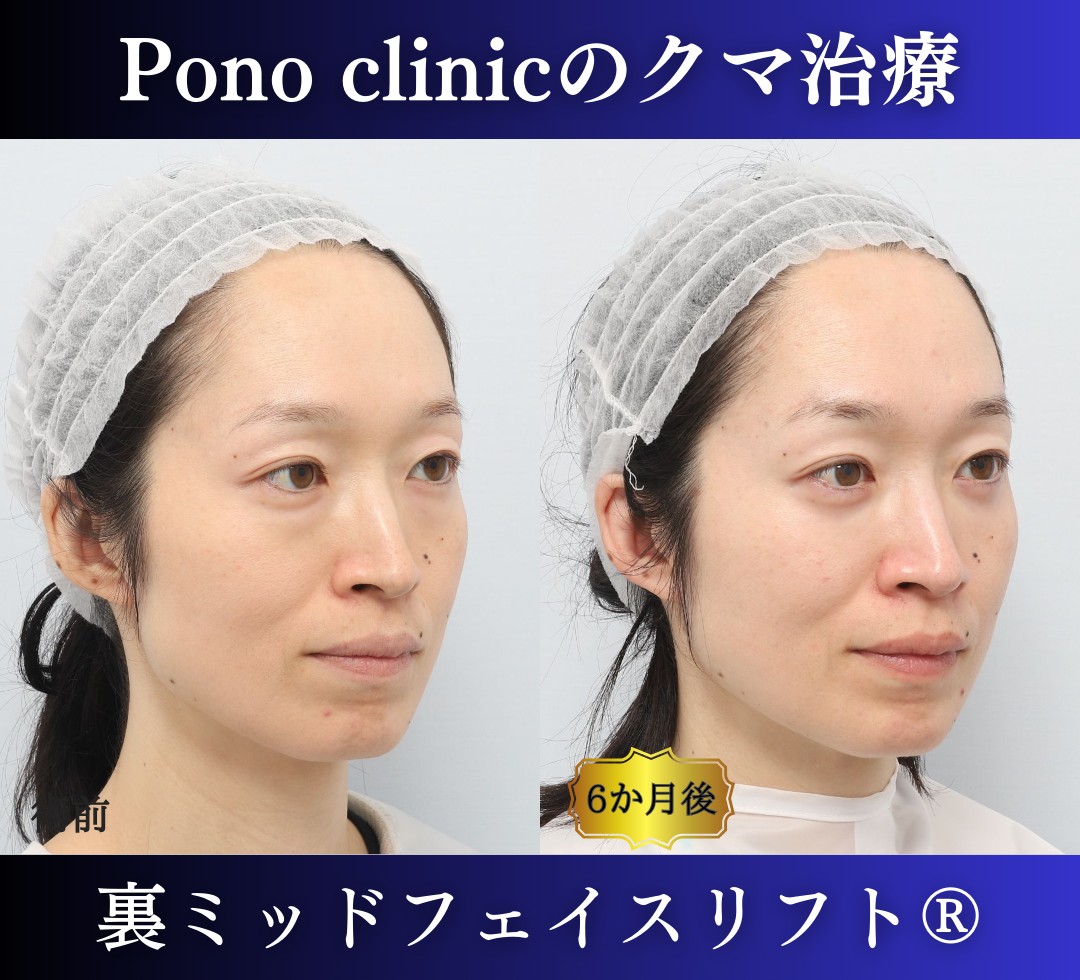 目の下のクマ取り、ハムラ法、40代女性の症例 (2)