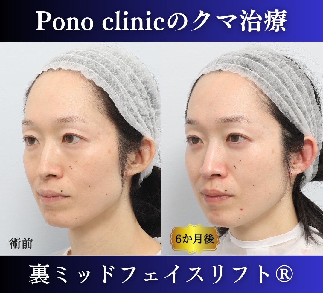 目の下のクマ取り、ハムラ法、40代女性の症例 (3)