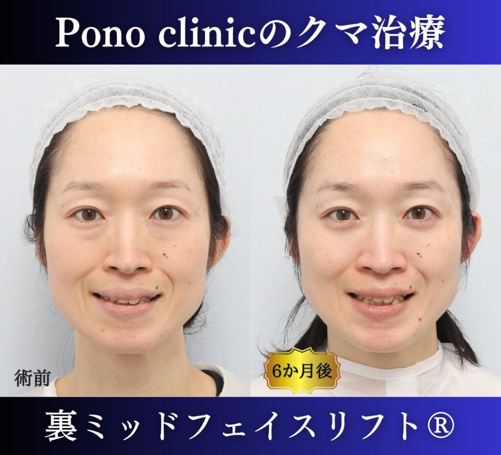 目の下のクマ取り、ハムラ法、40代女性の症例 (4)