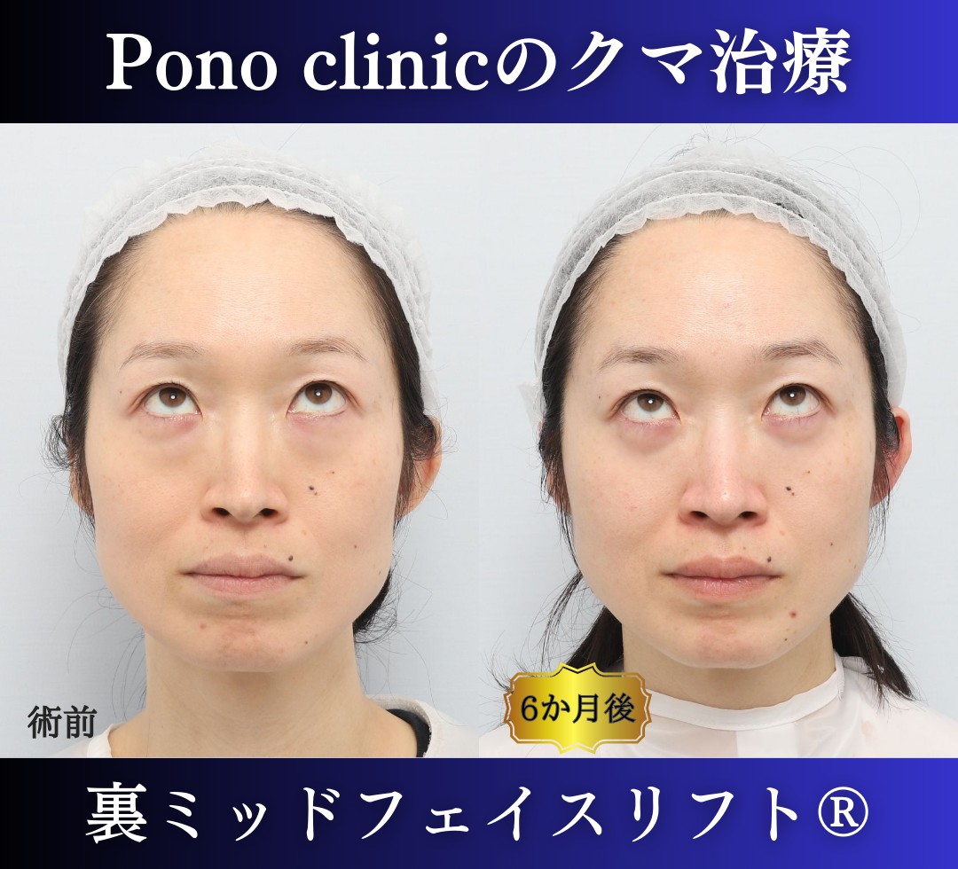 目の下のクマ取り、ハムラ法、40代女性の症例 (5)