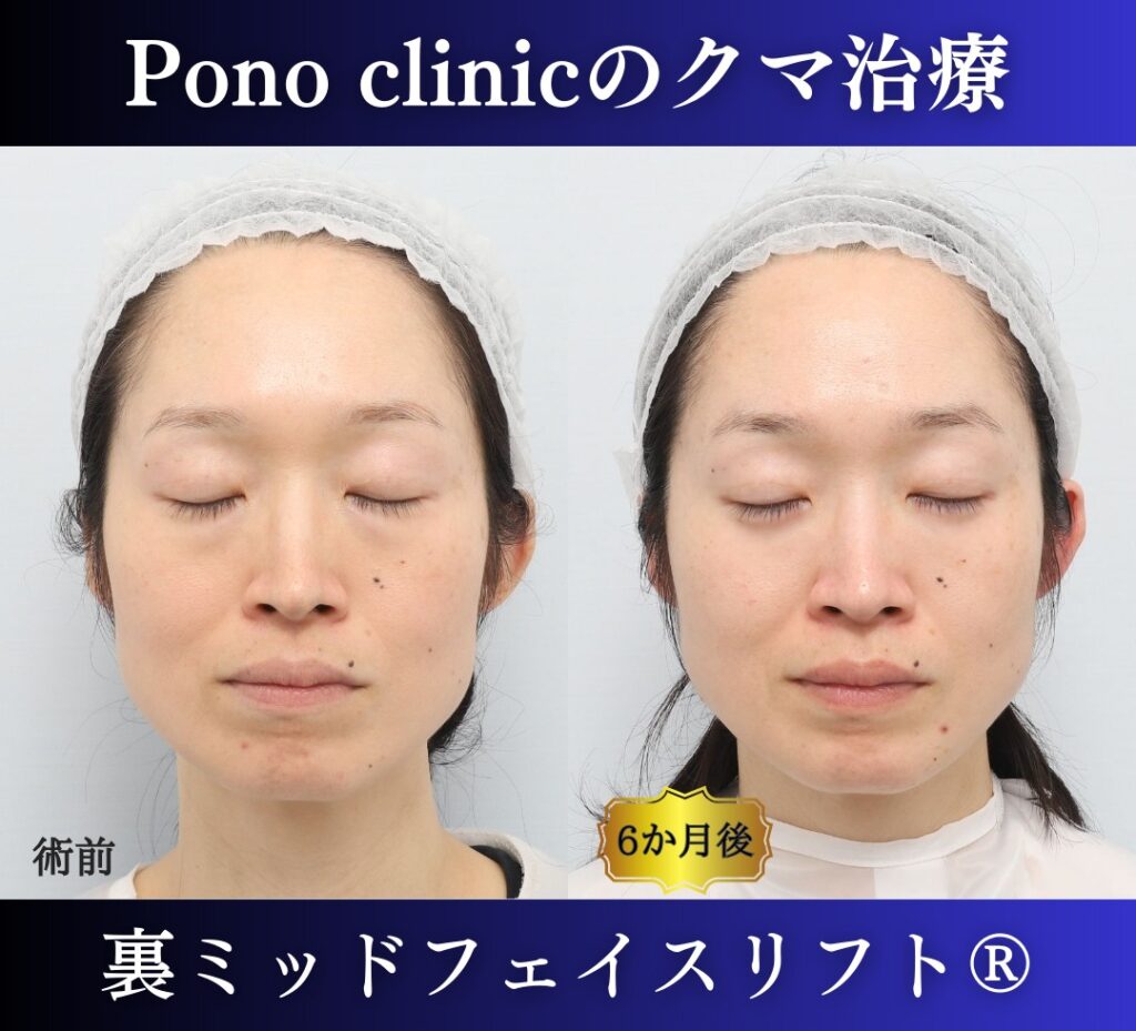 目の下のクマ取り、ハムラ法、40代女性の症例 (6)