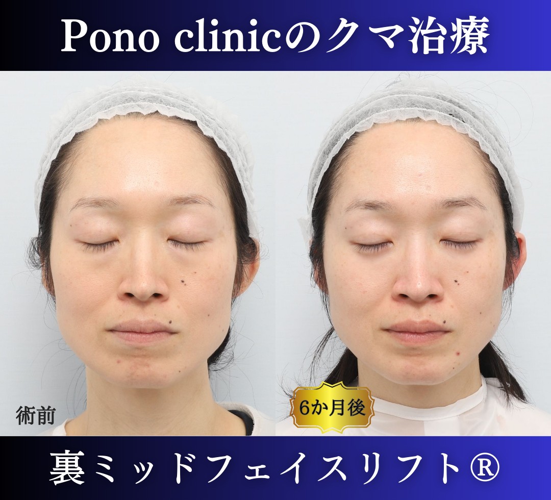 目の下のクマ取り、ハムラ法、40代女性の症例 (6)