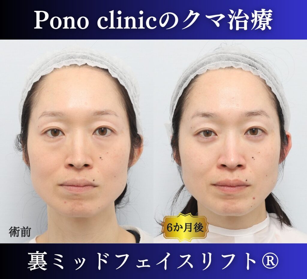 目の下のクマ取り、ハムラ法、40代女性の症例 (7)