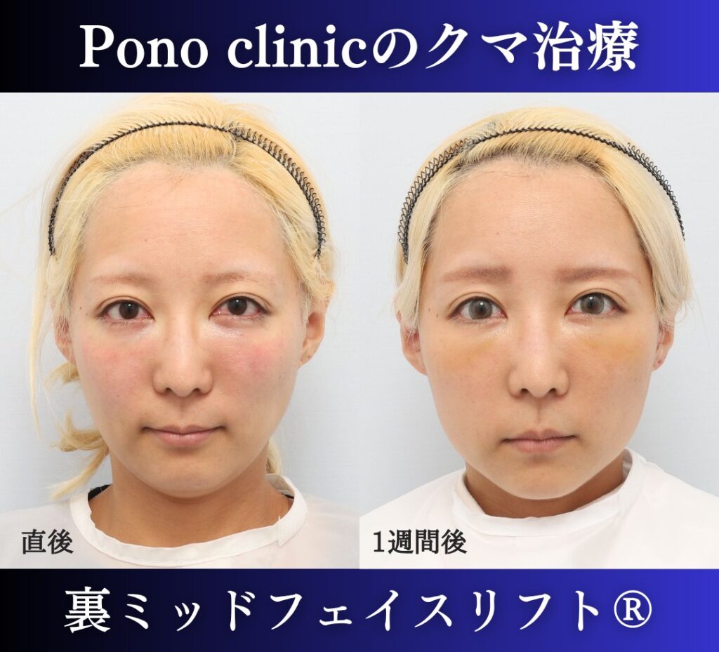 30代女性の症例、 目の下のクマ取り、裏ハムラ法、ミッドフェイスリフト (1)