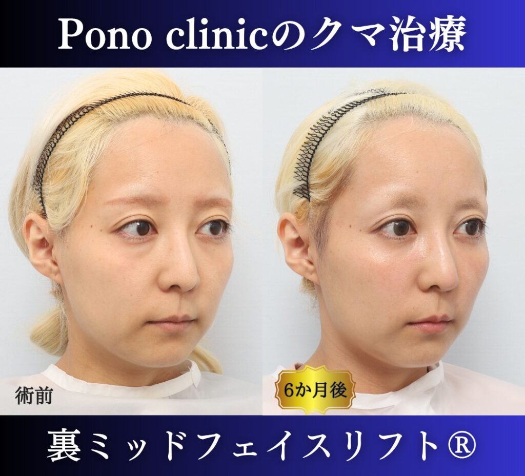 30代女性の症例、 目の下のクマ取り、裏ハムラ法、ミッドフェイスリフト (2)