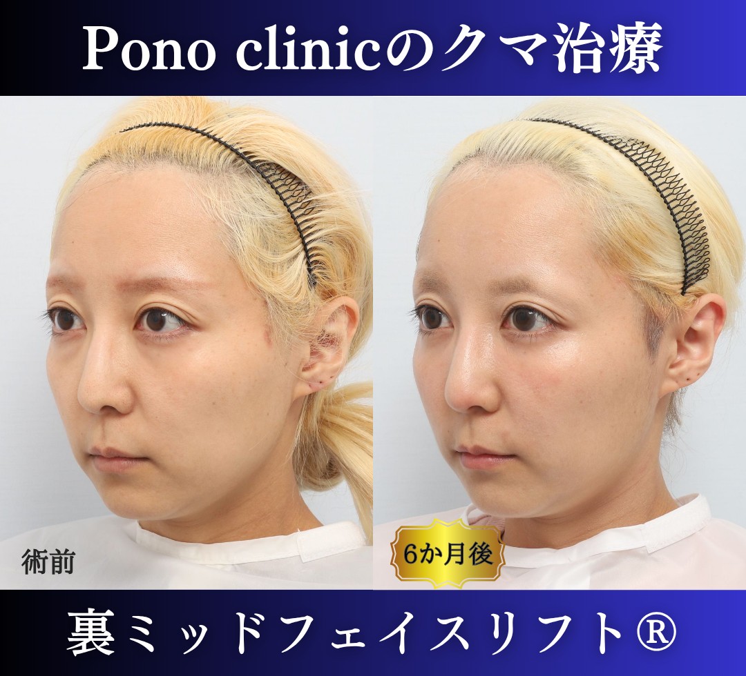 30代女性の症例、 目の下のクマ取り、裏ハムラ法、ミッドフェイスリフト (3)