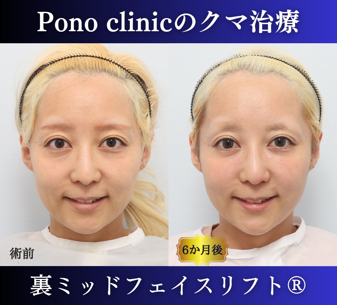 30代女性の症例、 目の下のクマ取り、裏ハムラ法、ミッドフェイスリフト (4)