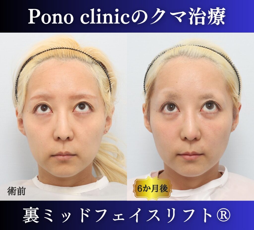 30代女性の症例、 目の下のクマ取り、裏ハムラ法、ミッドフェイスリフト (5)