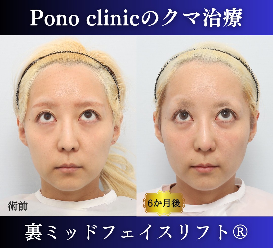 30代女性の症例、 目の下のクマ取り、裏ハムラ法、ミッドフェイスリフト (5)