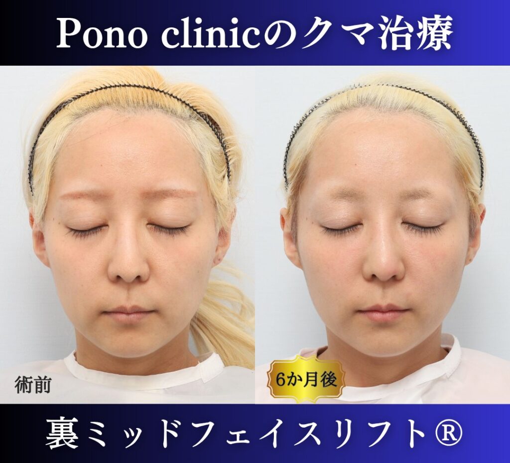 30代女性の症例、 目の下のクマ取り、裏ハムラ法、ミッドフェイスリフト (6)