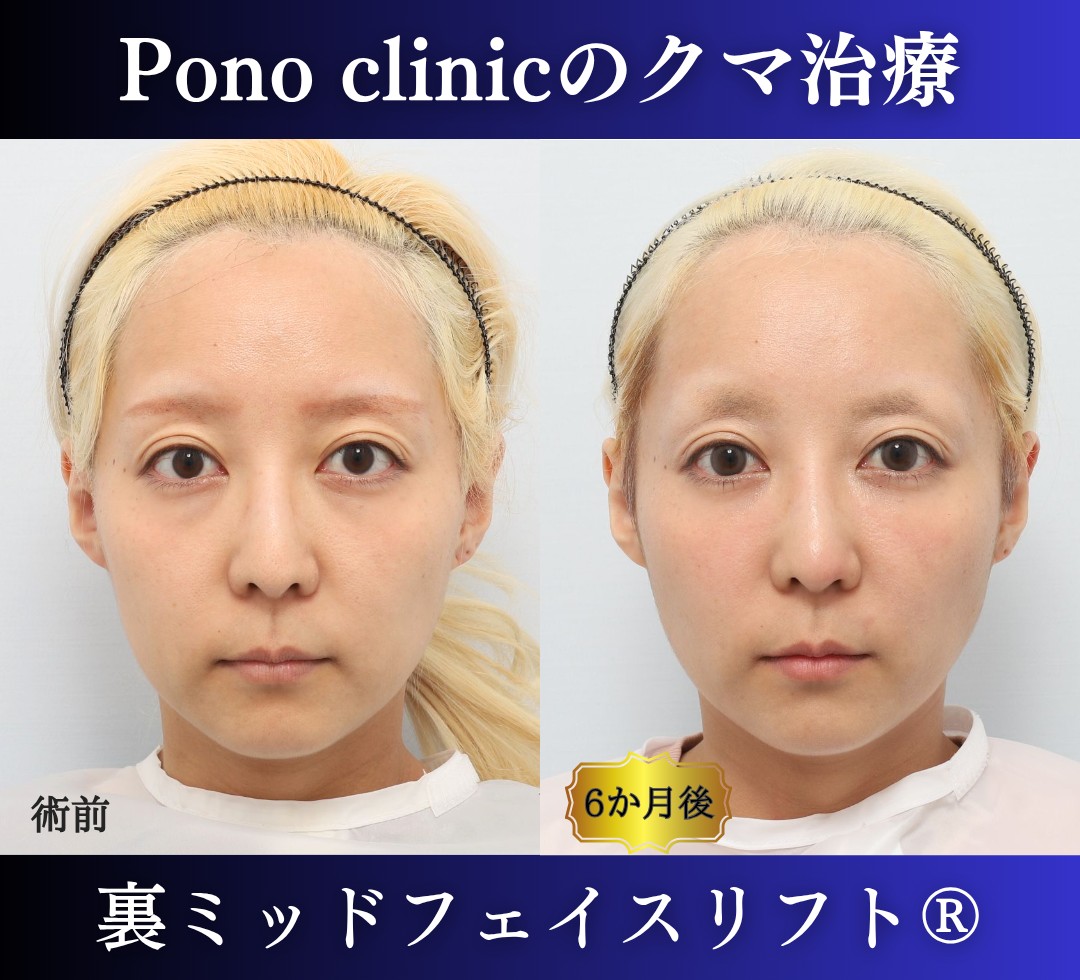 30代女性の症例、 目の下のクマ取り、裏ハムラ法、ミッドフェイスリフト (7)