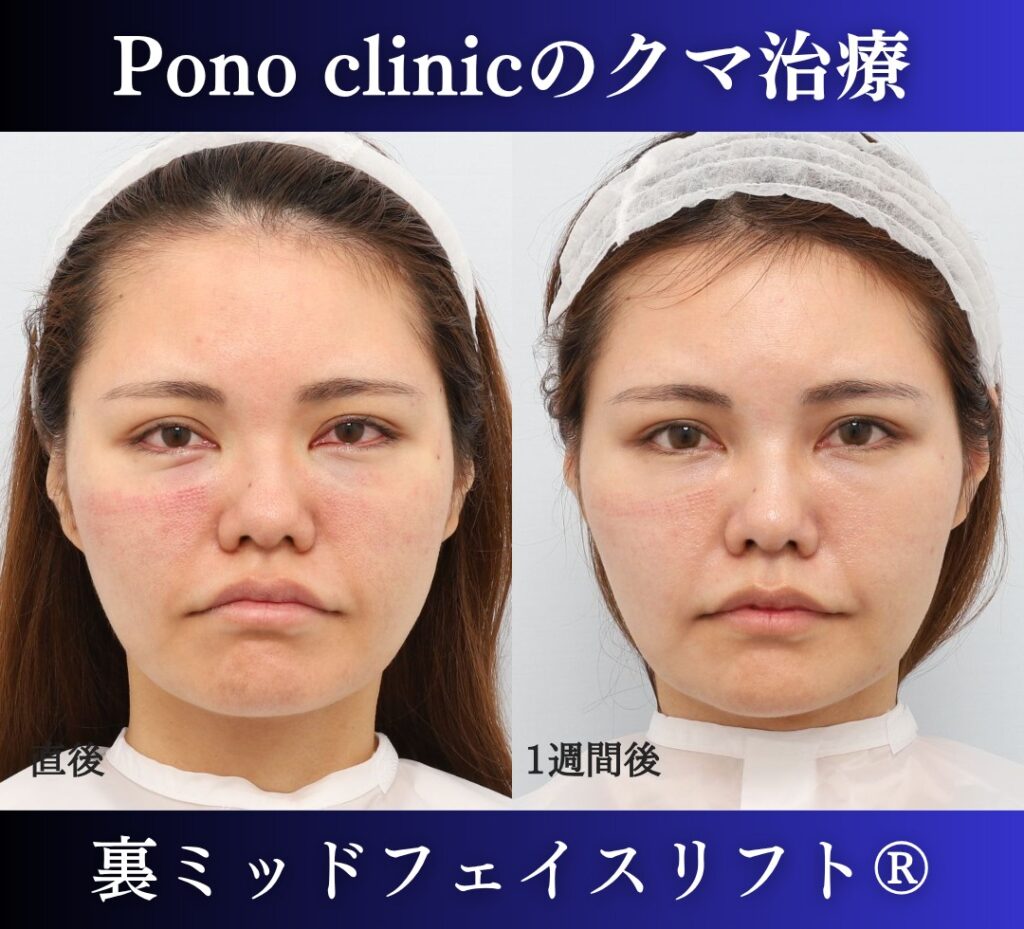 30代女性の症例、目の下のクマ取り、裏ハムラ、裏ミッドフェイスリフト (1)