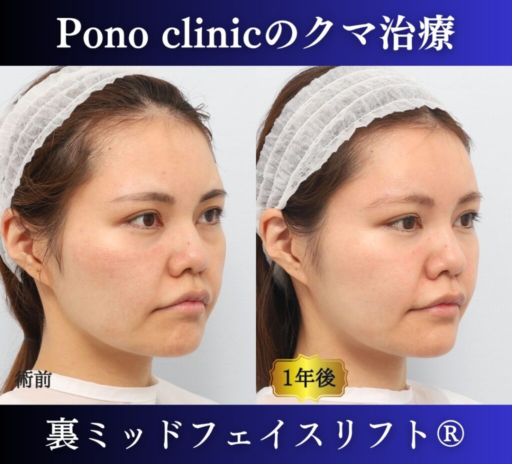 30代女性の症例、目の下のクマ取り、裏ハムラ、裏ミッドフェイスリフト (2)