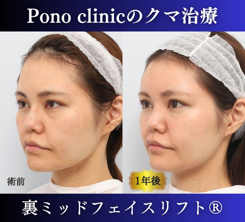 30代女性の症例、目の下のクマ取り、裏ハムラ、裏ミッドフェイスリフト (3)