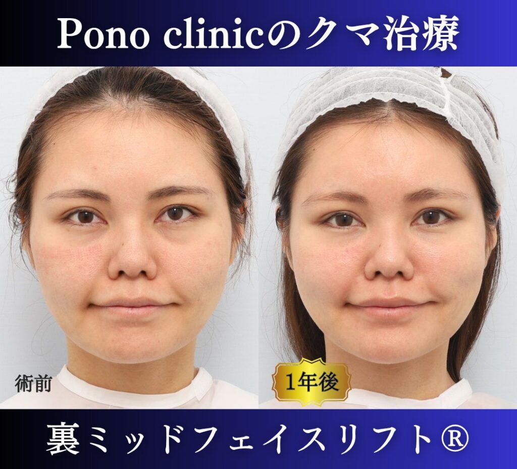 30代女性の症例、目の下のクマ取り、裏ハムラ、裏ミッドフェイスリフト (4)