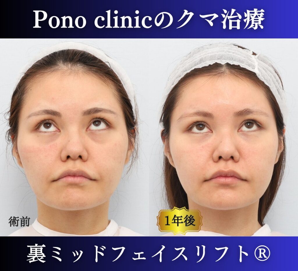 30代女性の症例、目の下のクマ取り、裏ハムラ、裏ミッドフェイスリフト (5)