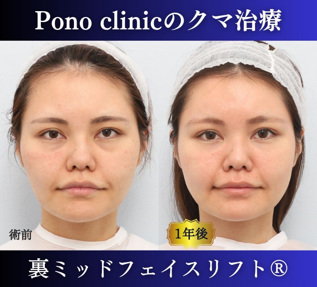 30代女性の症例、目の下のクマ取り、裏ハムラ、裏ミッドフェイスリフト (6)