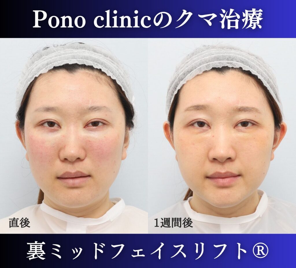 30代女性の症例、目の下のクマ取り、裏ハムラ法、ミッドフェイスリフト (1)