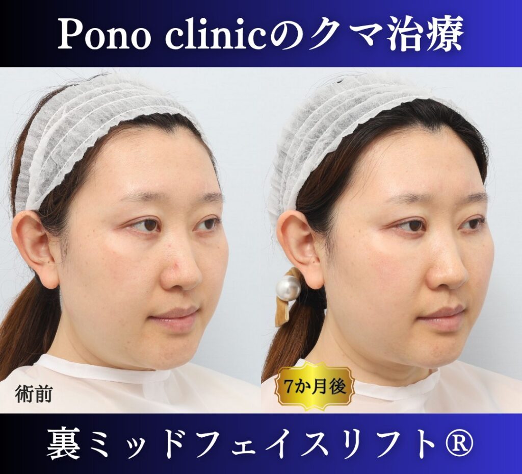 30代女性の症例、目の下のクマ取り、裏ハムラ法、ミッドフェイスリフト (2)