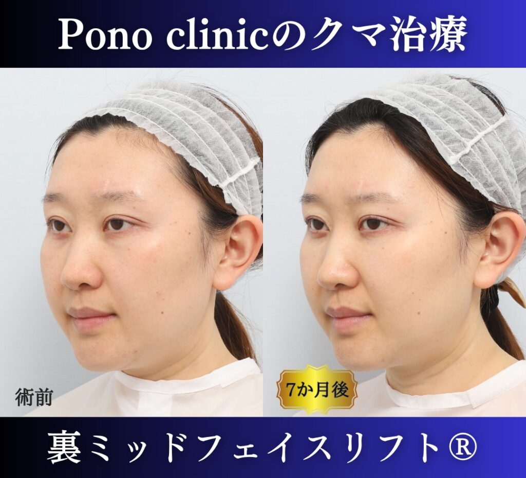 30代女性の症例、目の下のクマ取り、裏ハムラ法、ミッドフェイスリフト (3