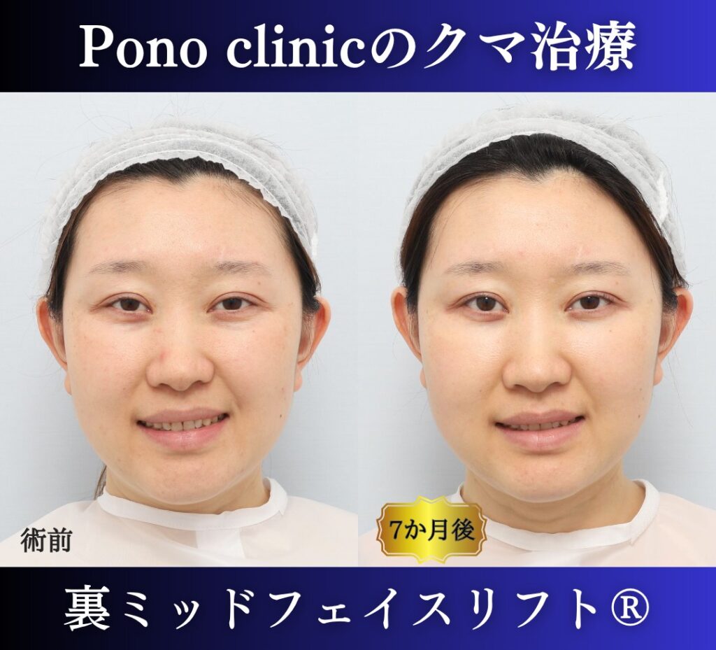 30代女性の症例、目の下のクマ取り、裏ハムラ法、ミッドフェイスリフト (4)