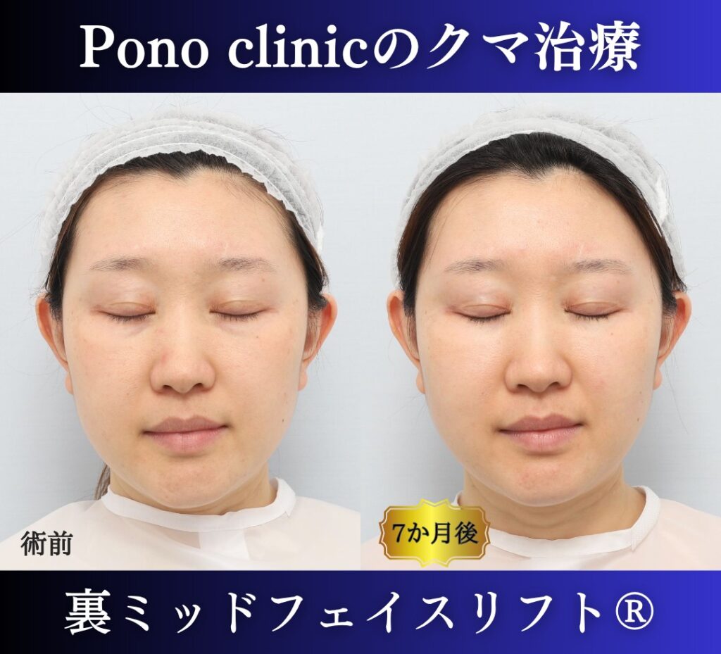 30代女性の症例、目の下のクマ取り、裏ハムラ法、ミッドフェイスリフト (5)