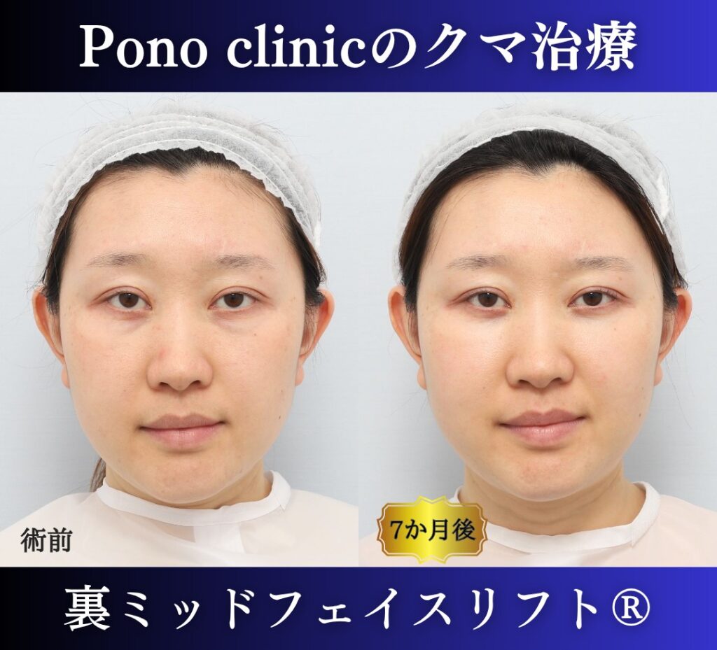 30代女性の症例、目の下のクマ取り、裏ハムラ法、ミッドフェイスリフト (6)