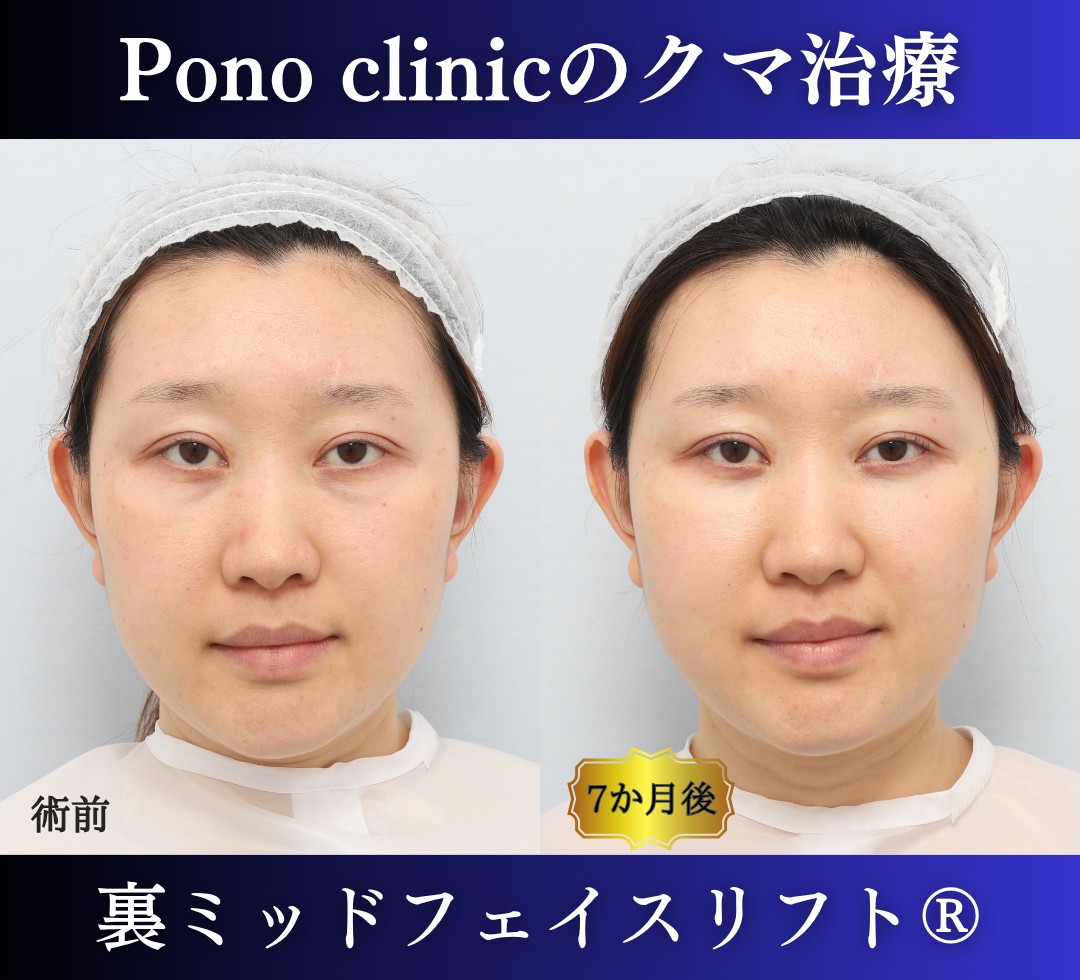 30代女性の症例、目の下のクマ取り、裏ハムラ法、ミッドフェイスリフト (6)