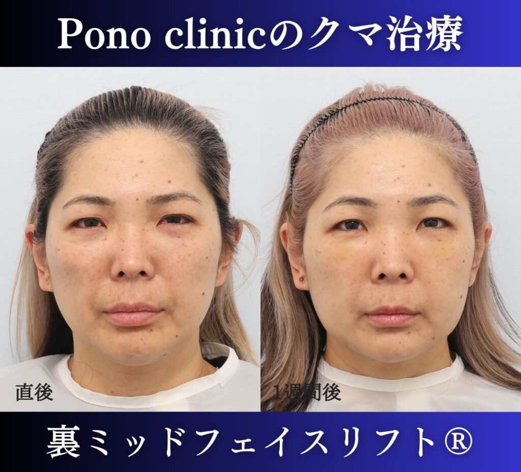 40代女性のクマ治療、目の下のクマ取り、裏ハムラ法、ミッドフェイスリフト (1)