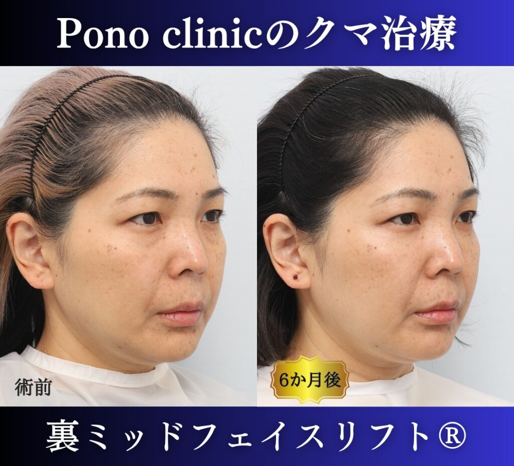 40代女性のクマ治療、目の下のクマ取り、裏ハムラ法、ミッドフェイスリフト (2)