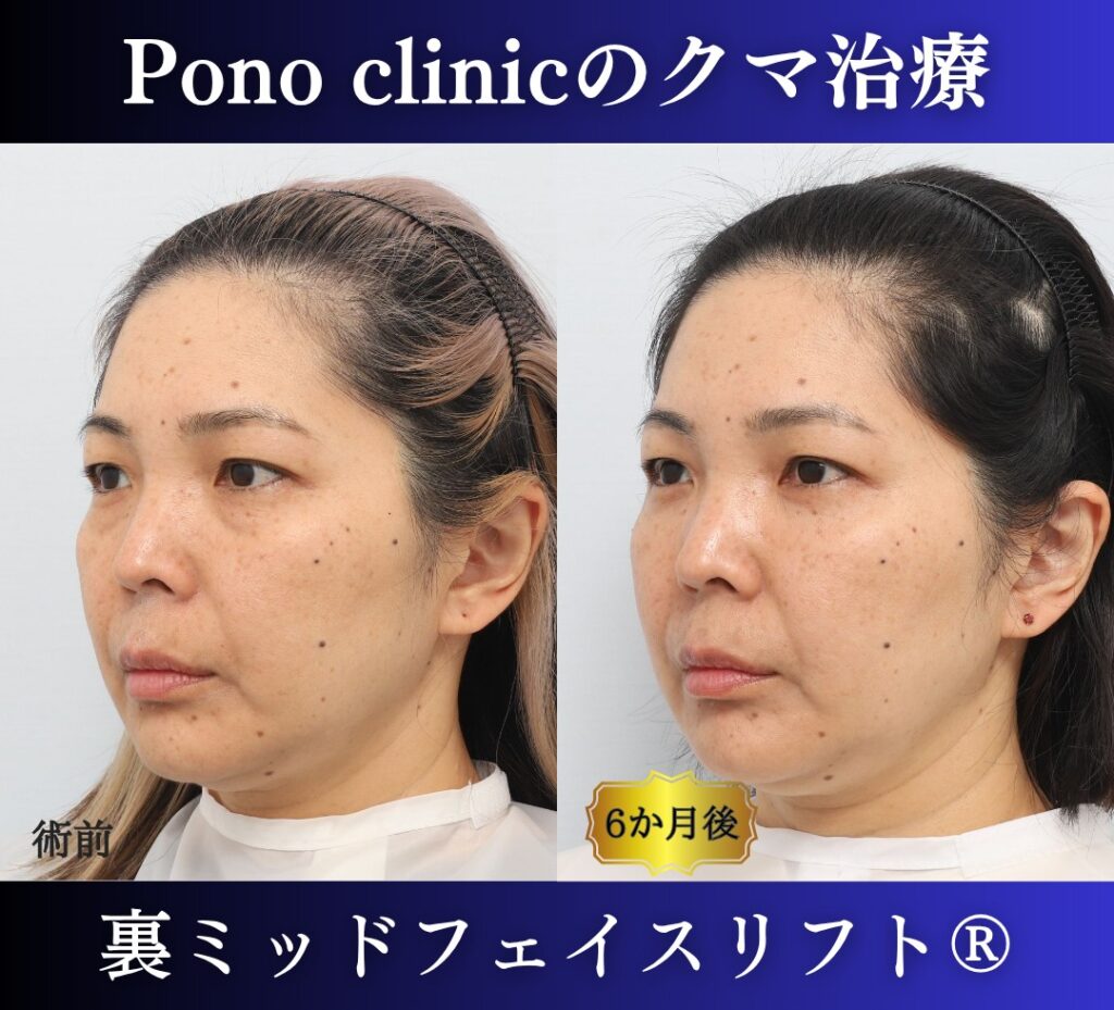 40代女性のクマ治療、目の下のクマ取り、裏ハムラ法、ミッドフェイスリフト (3)