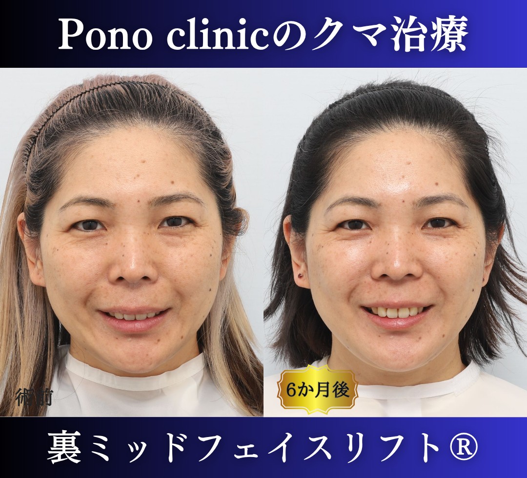 40代女性のクマ治療、目の下のクマ取り、裏ハムラ法、ミッドフェイスリフト (4)