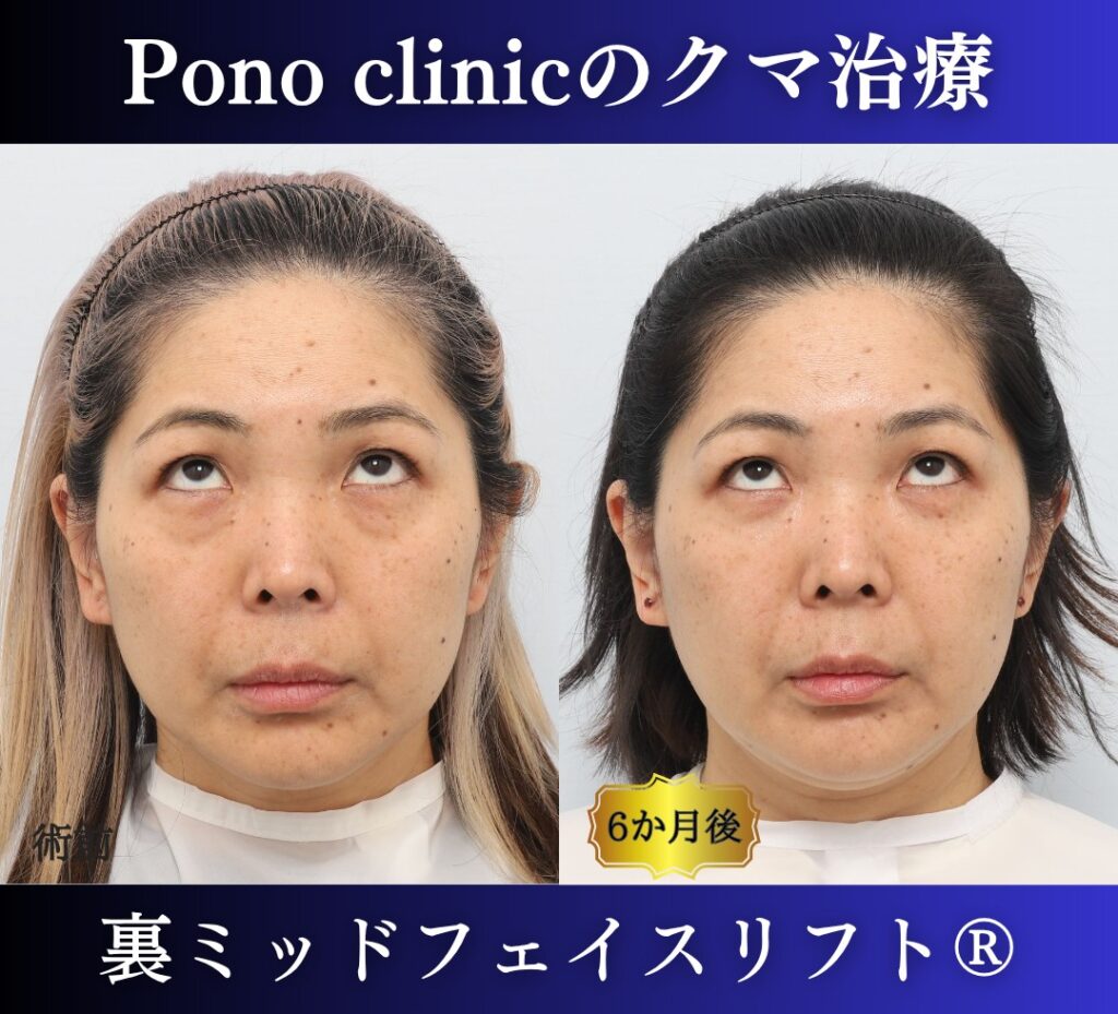 40代女性のクマ治療、目の下のクマ取り、裏ハムラ法、ミッドフェイスリフト (5)