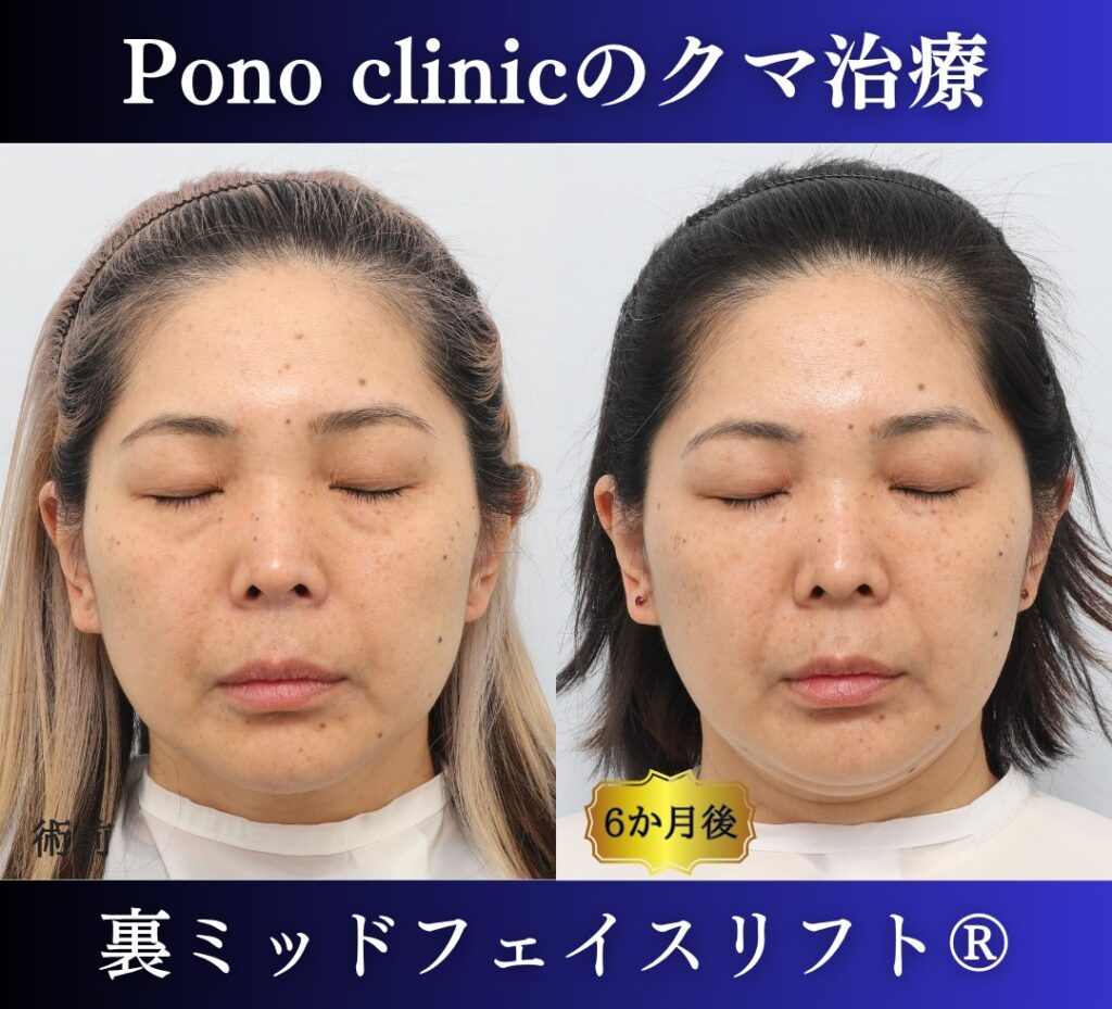 40代女性のクマ治療、目の下のクマ取り、裏ハムラ法、ミッドフェイスリフト (6)
