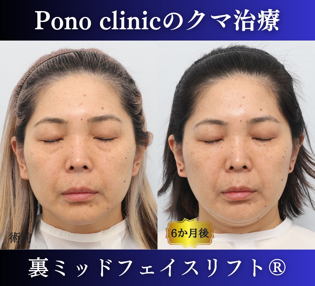 40代女性のクマ治療、目の下のクマ取り、裏ハムラ法、ミッドフェイスリフト (6)