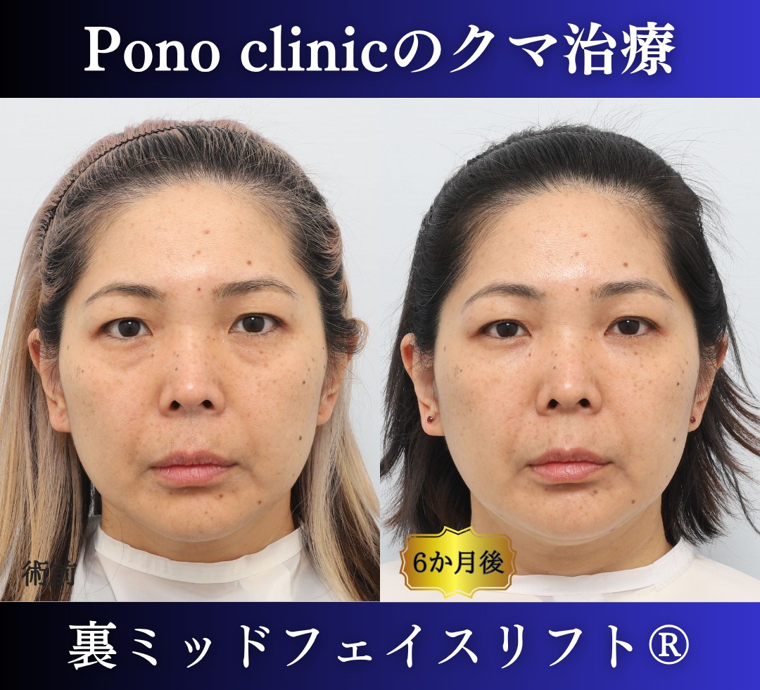 40代女性のクマ治療、目の下のクマ取り、裏ハムラ法、ミッドフェイスリフト (7)