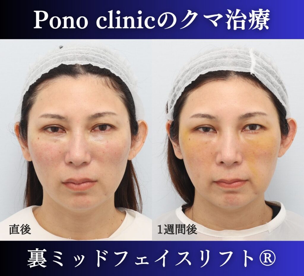 40代女性の症例、目の下のクマ取り、裏ハムラ法、ミッドフェイスリフト、二重埋没法 (1)