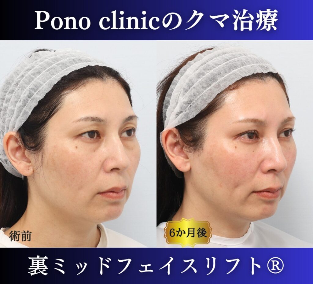 40代女性の症例、目の下のクマ取り、裏ハムラ法、ミッドフェイスリフト、二重埋没法 (2)