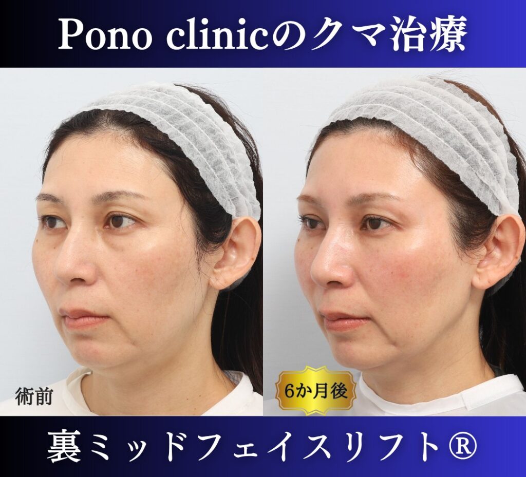 40代女性の症例、目の下のクマ取り、裏ハムラ法、ミッドフェイスリフト、二重埋没法 (3)