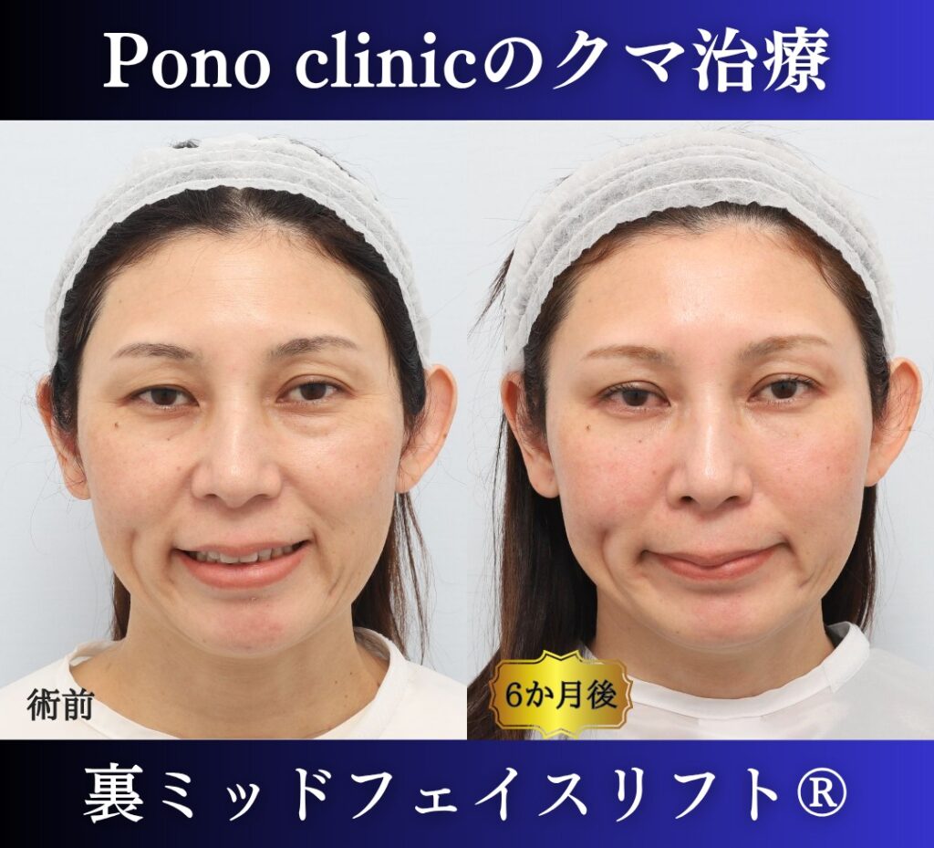 40代女性の症例、目の下のクマ取り、裏ハムラ法、ミッドフェイスリフト、二重埋没法 (4)