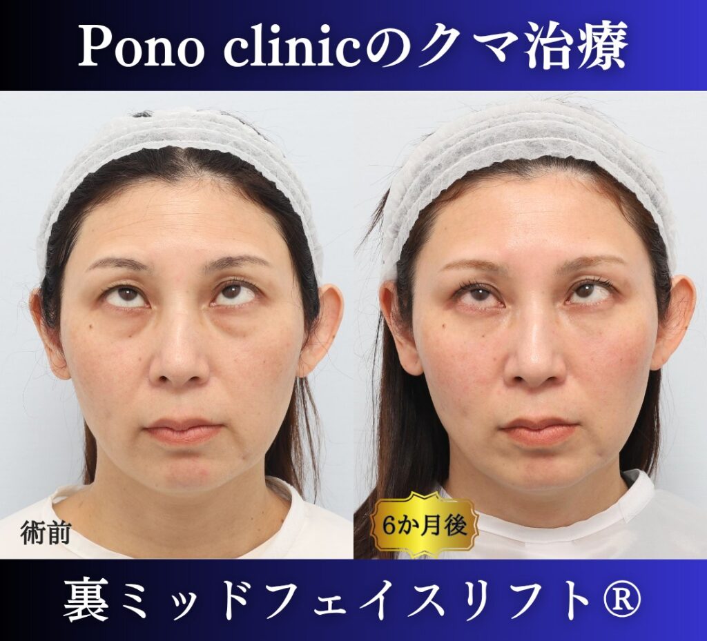 40代女性の症例、目の下のクマ取り、裏ハムラ法、ミッドフェイスリフト、二重埋没法 (5)