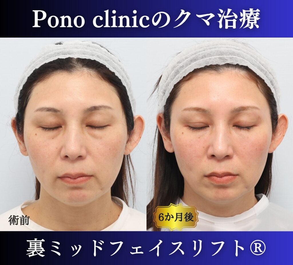 40代女性の症例、目の下のクマ取り、裏ハムラ法、ミッドフェイスリフト、二重埋没法 (6)