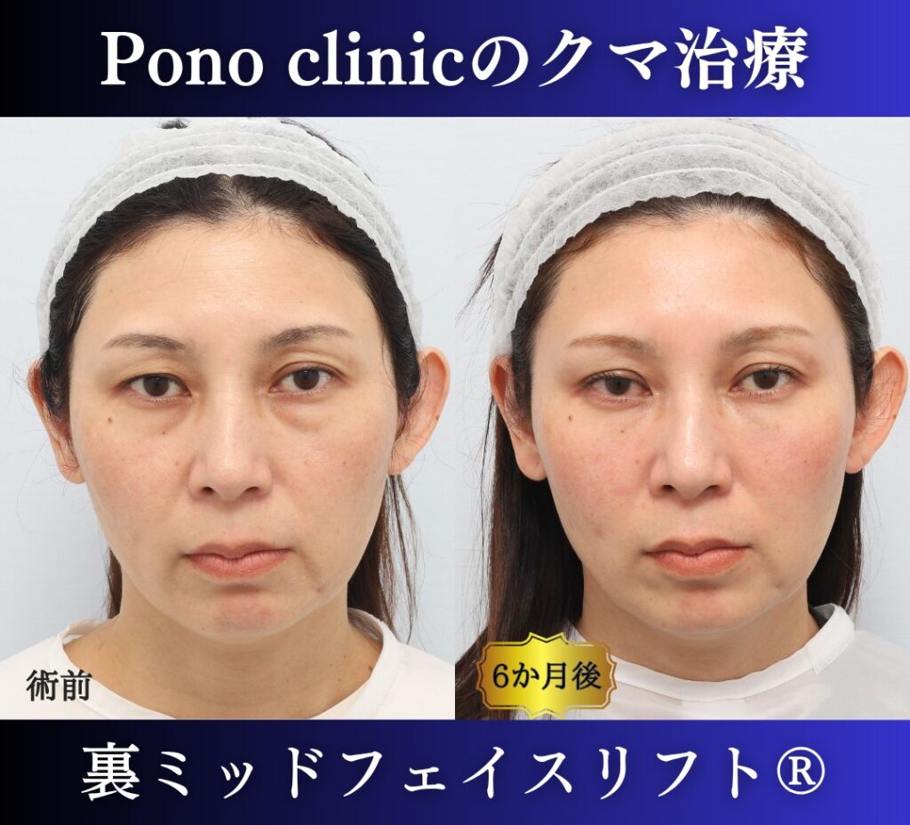 40代女性の症例、目の下のクマ取り、裏ハムラ法、ミッドフェイスリフト、二重埋没法 (7)